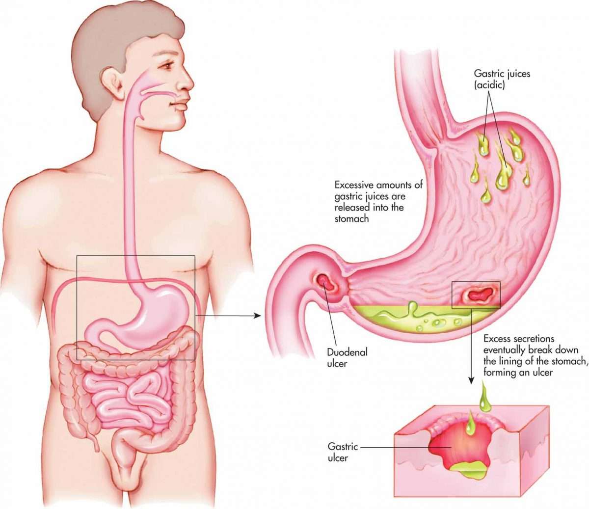 Peptic Ulcer Symptoms List