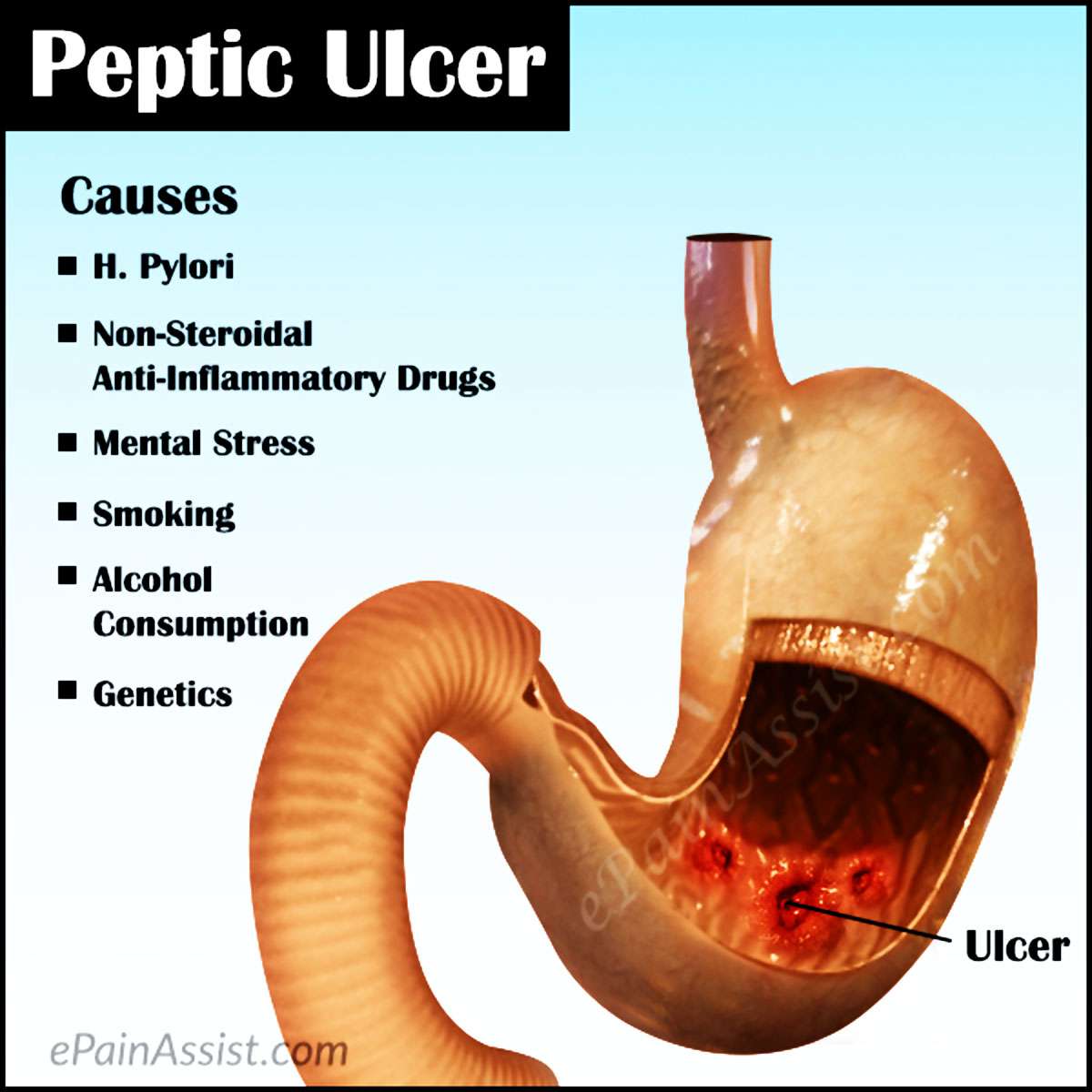 Peptic Ulcer: Treatment, Causes, Symptoms, Types, Tests