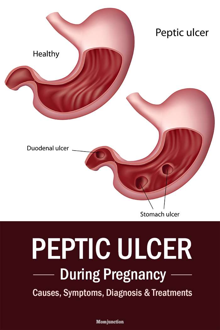 Peptic/Stomach Ulcer During Pregnancy
