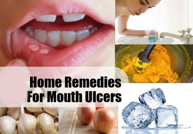 Perfect Home Remedies for Mouth Ulcers