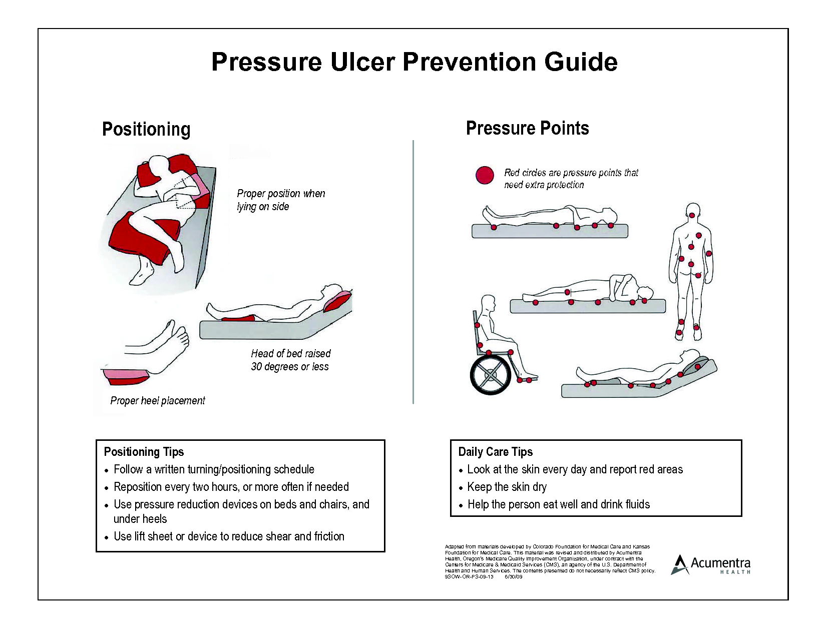 Preventing pressure ulcers. Causes, symptoms, treatment ...