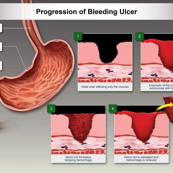 Progression of Bleeding Ulcer