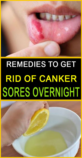 Remedies To Get Rid Of Canker Sores Overnight