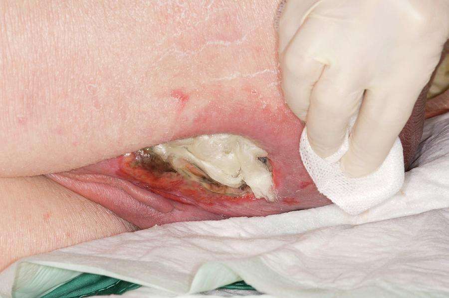 Sacral Pressure Ulcer Treatment Photograph by Dr P ...
