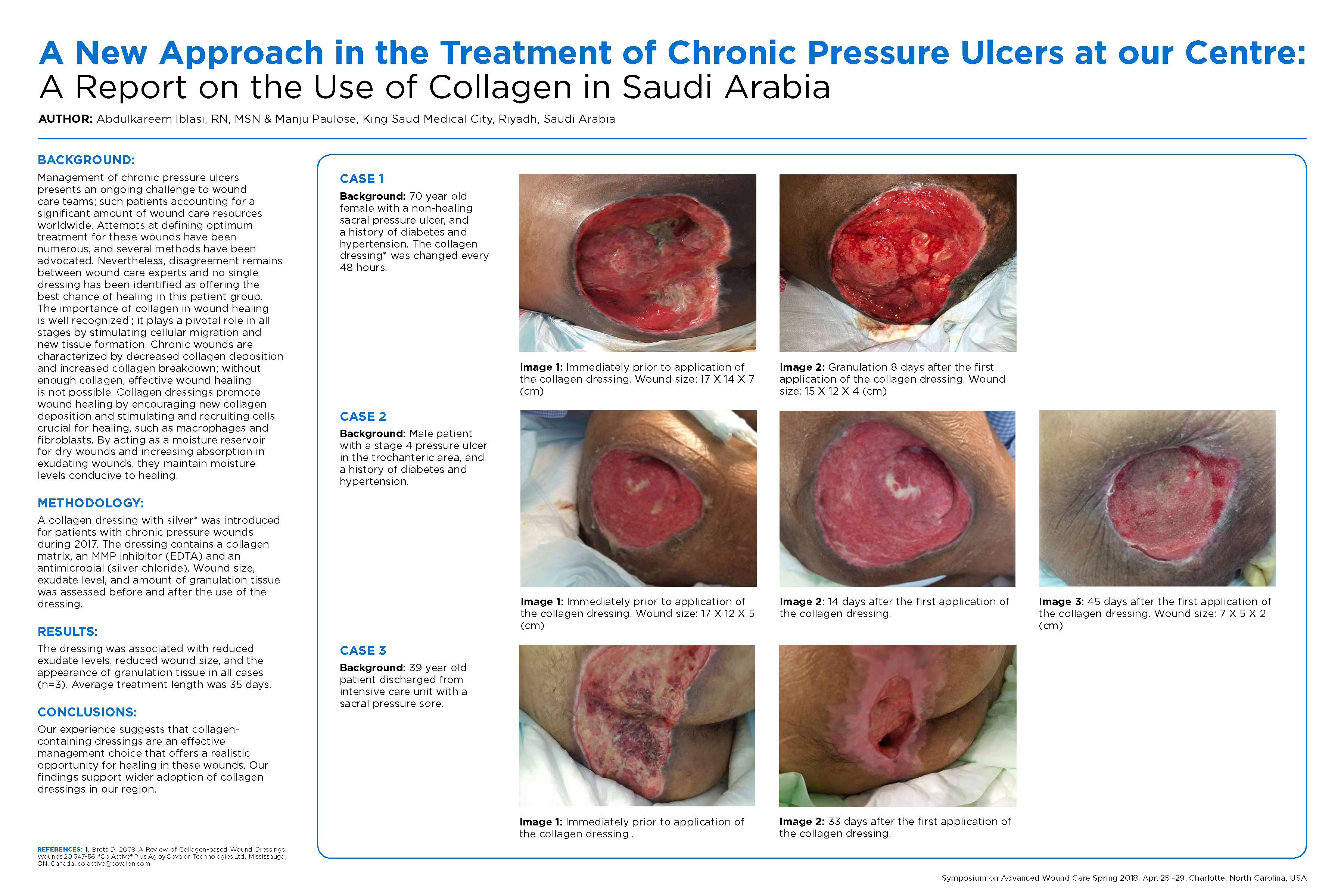 Stage 3 Pressure Ulcer Treatment
