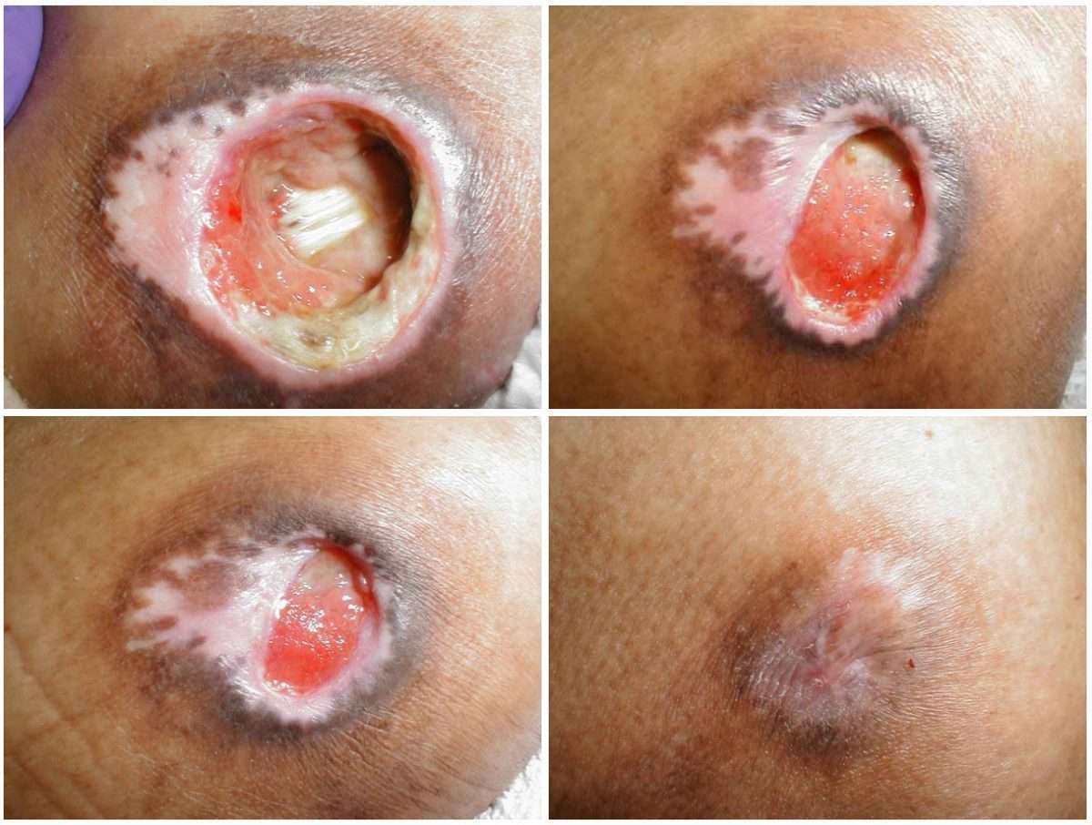 Stage 3 Sacral Pressure Ulcer : Stages Of Healing Decubitus Ulcer Upper ...