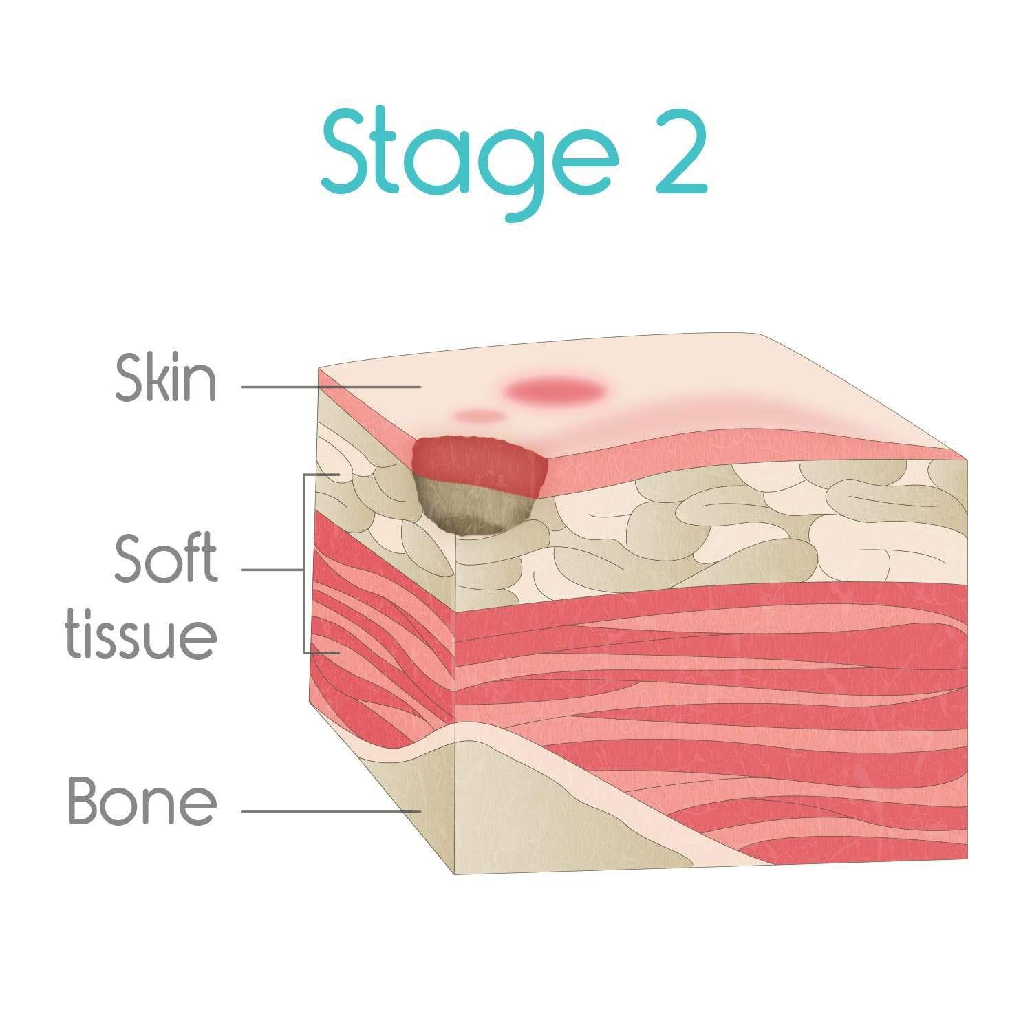stage two bed sores