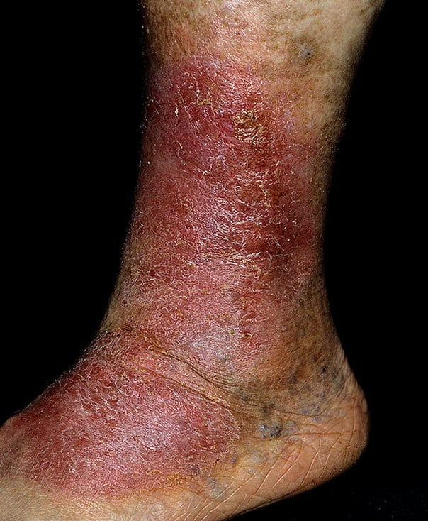Stasis Dermatitis on Legs Pictures â 174 Photos &  Images / illnessee.com