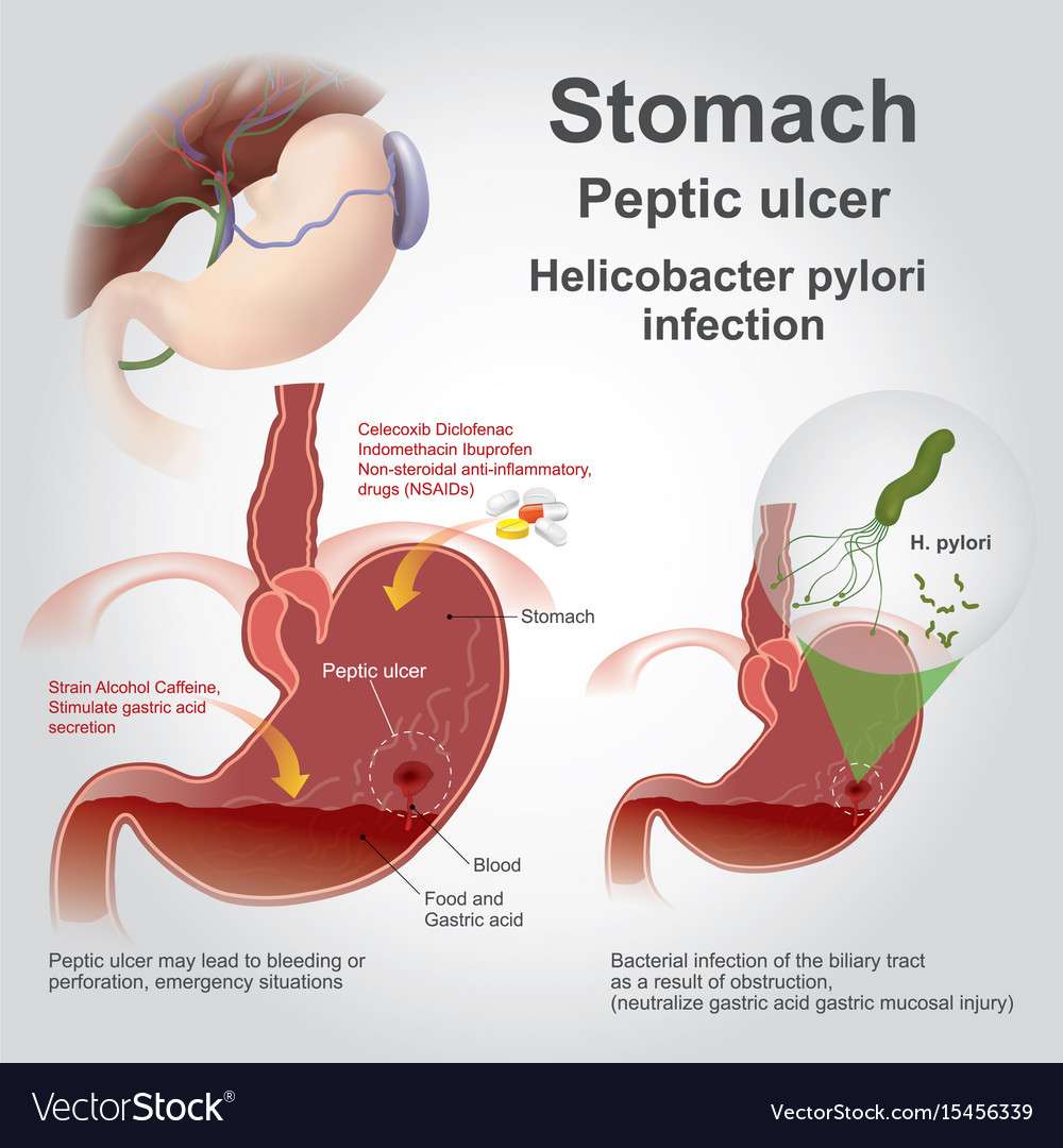Stomach peptic ulcer charts Royalty Free Vector Image