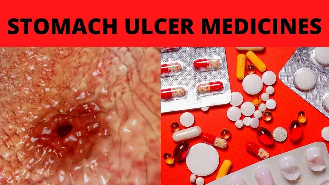 Stomach Ulcer Best Medicine