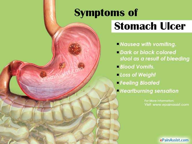 Stomach Ulcer or Peptic Ulcer Disease