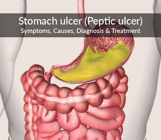 Stomach ulcer (Peptic ulcer) : Symptoms, Causes, Diagnosis &  Treatment