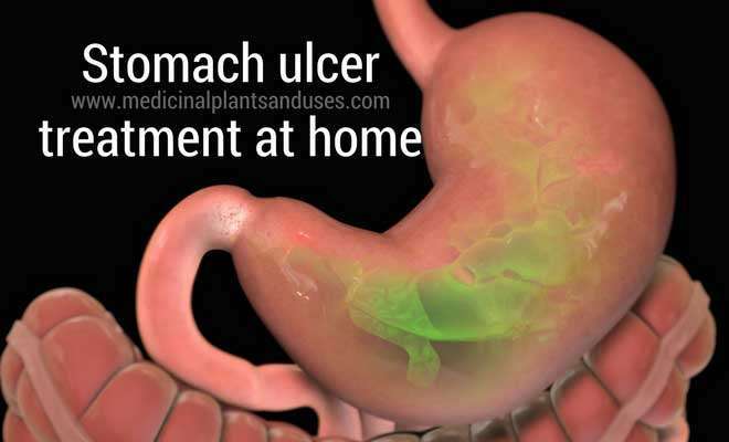 Stomach ulcer treatment at home, causes and symptoms