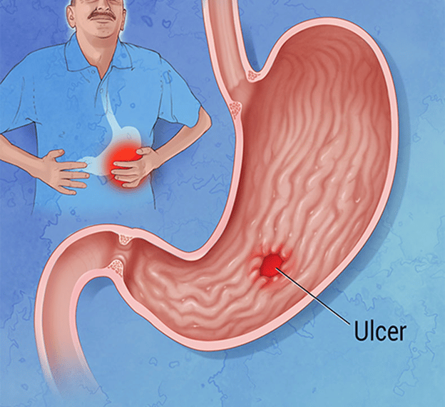 Stomach ulcer