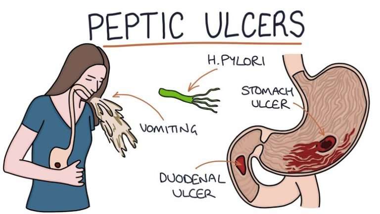 Stomach Ulcer(Peptic Ulcer): Symptoms and Causes  Page 7  Entirely Health