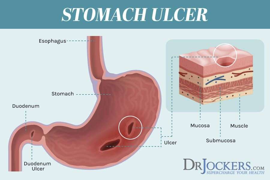 Stomach Ulcers: Causes and Natural Support Strategies