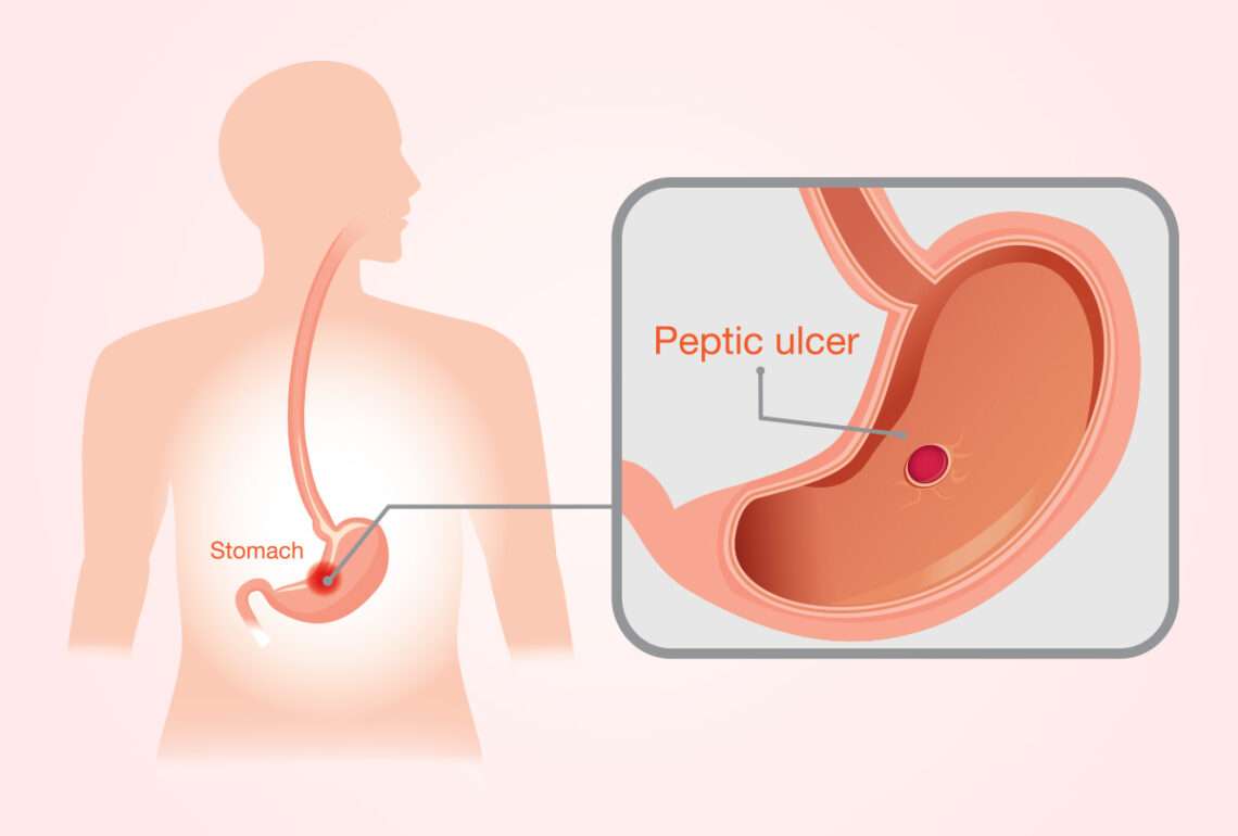 Stomach Ulcers: Causes, Risks, Treatment, &  Self