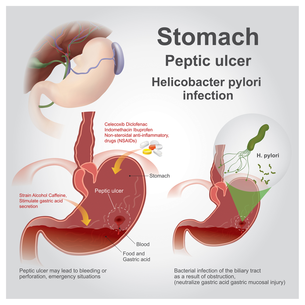 Symptoms of Stomach Ulcers