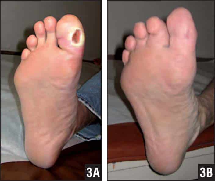 Tendon Lengthening for Neuropathic Foot Problems