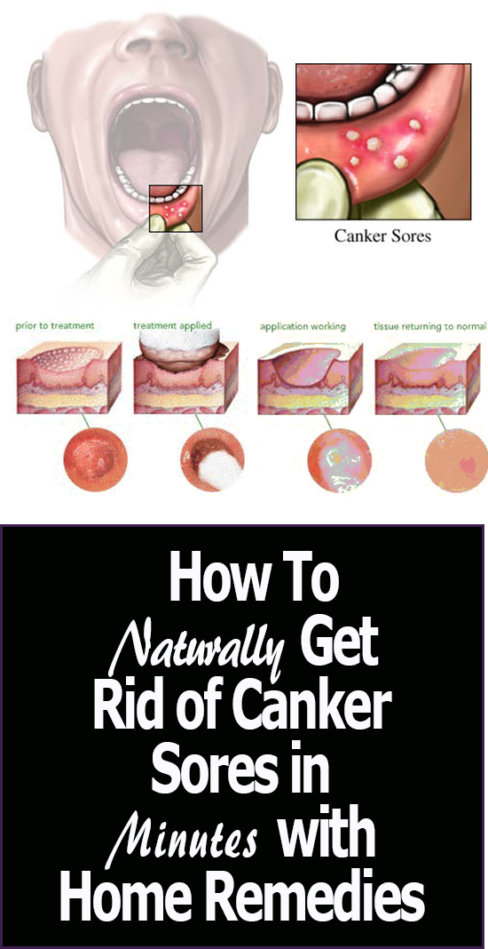 The 25+ best Canker sore medication ideas on Pinterest ...