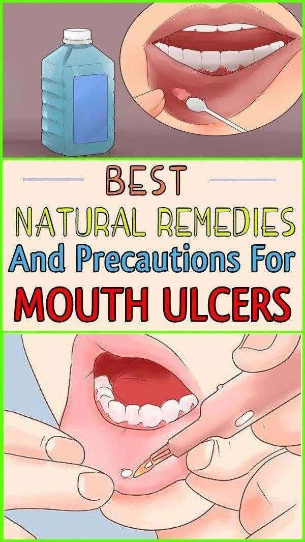The Best Natural Remedies and Precautions For Mouth Ulcers ...
