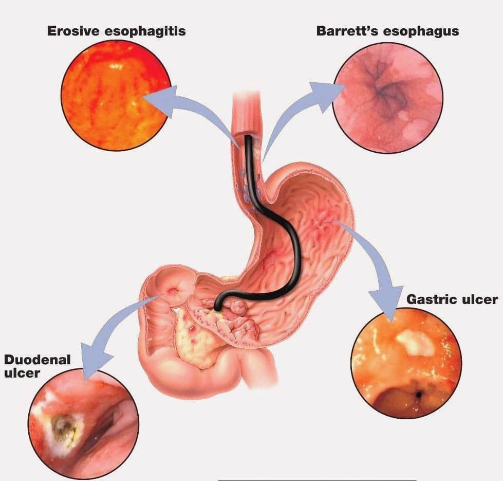 The Health Website : Gastric (Stomach) ulcer