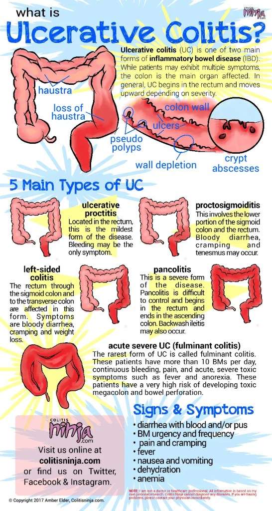 The Ins and Outs of Ulcerative Colitis
