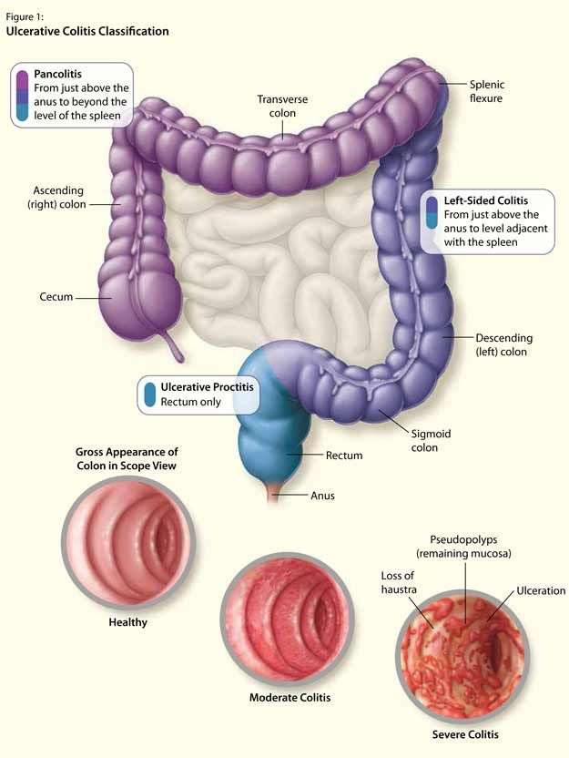 The Latest in Ulcerative Colitis Care, an interactive supplement on ...