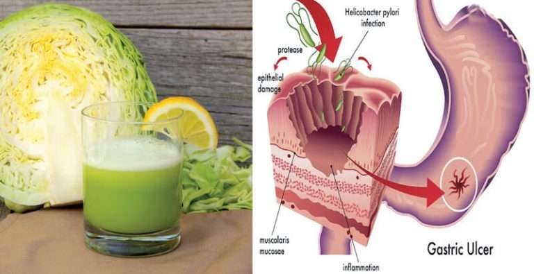 This Cabbage Juice Heals Stomach Ulcers, Detoxifies The Liver And ...