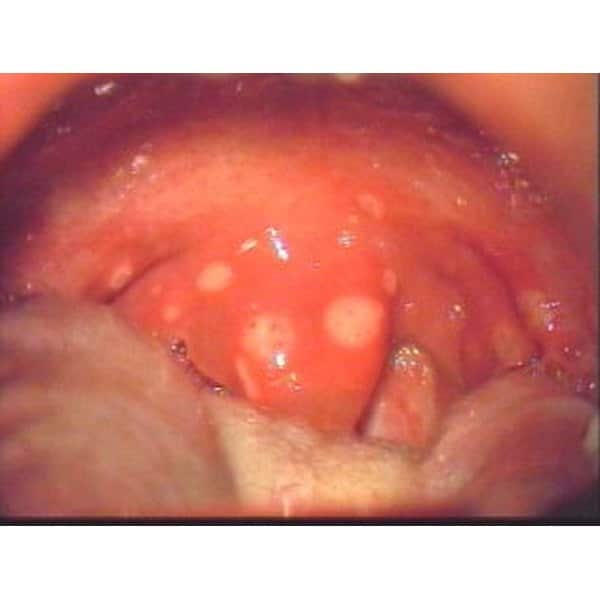 Throat Ulcer Symptoms