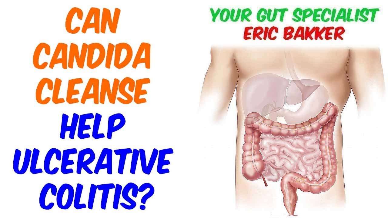 Treating Ulcerative Colitis With A Candida Cleanse ...