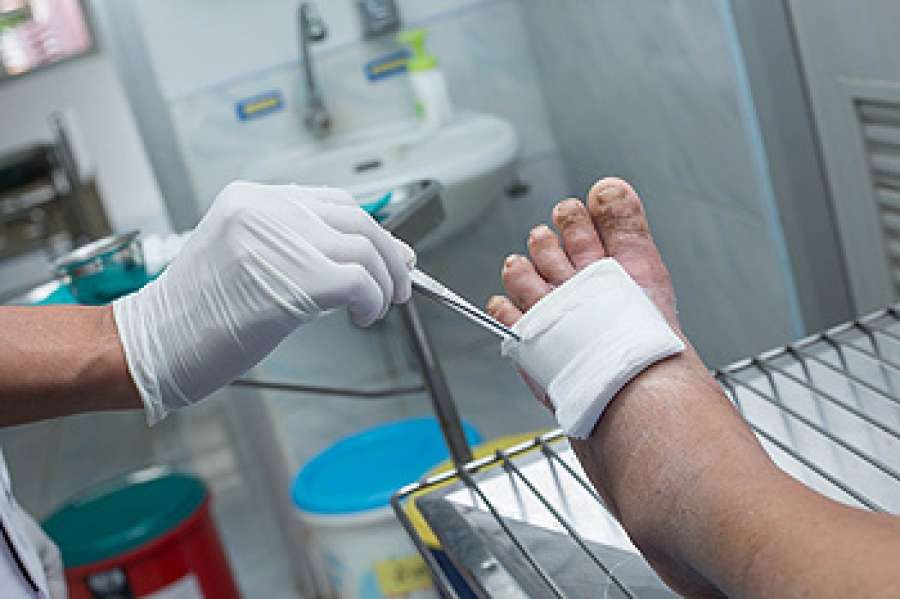Treatments for Diabetic Foot Ulcers