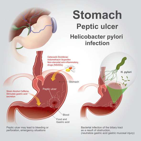 Trust Your Gut When it Comes to Stomach Ulcers