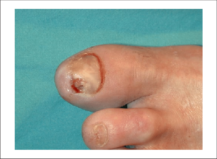 Ulcer and suppuration the external side of the big toe ...