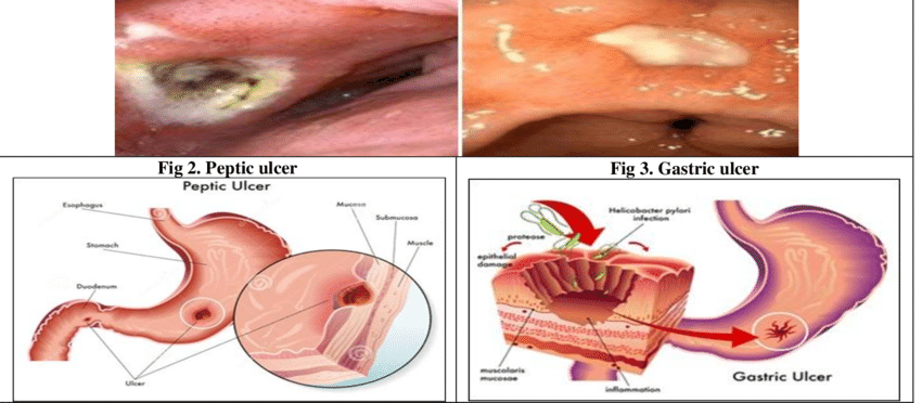 Ulcer caused by H. pylori in Duodenum and GIT