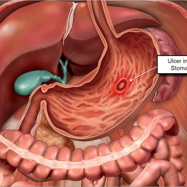 Ulcer in the Stomach