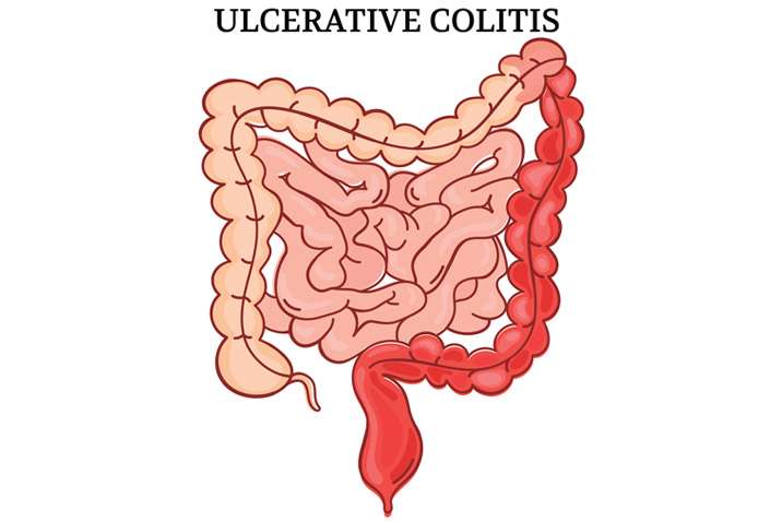 Ulcerative Colitis â Causes, Symptoms &  Treatment ...