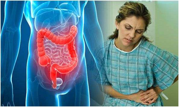 Ulcerative Colitis: A complete Guide to Support you with ...