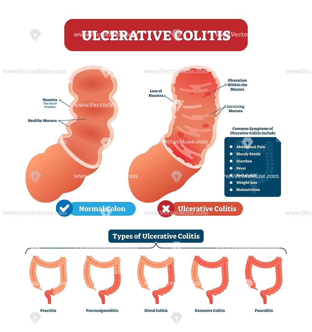 Ulcerative colitis anatomical vector illustration diagram ...