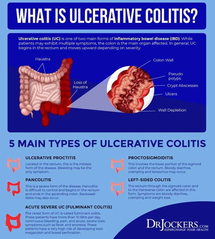 Ulcerative Colitis: Causes, Symptoms and Natural Support ...