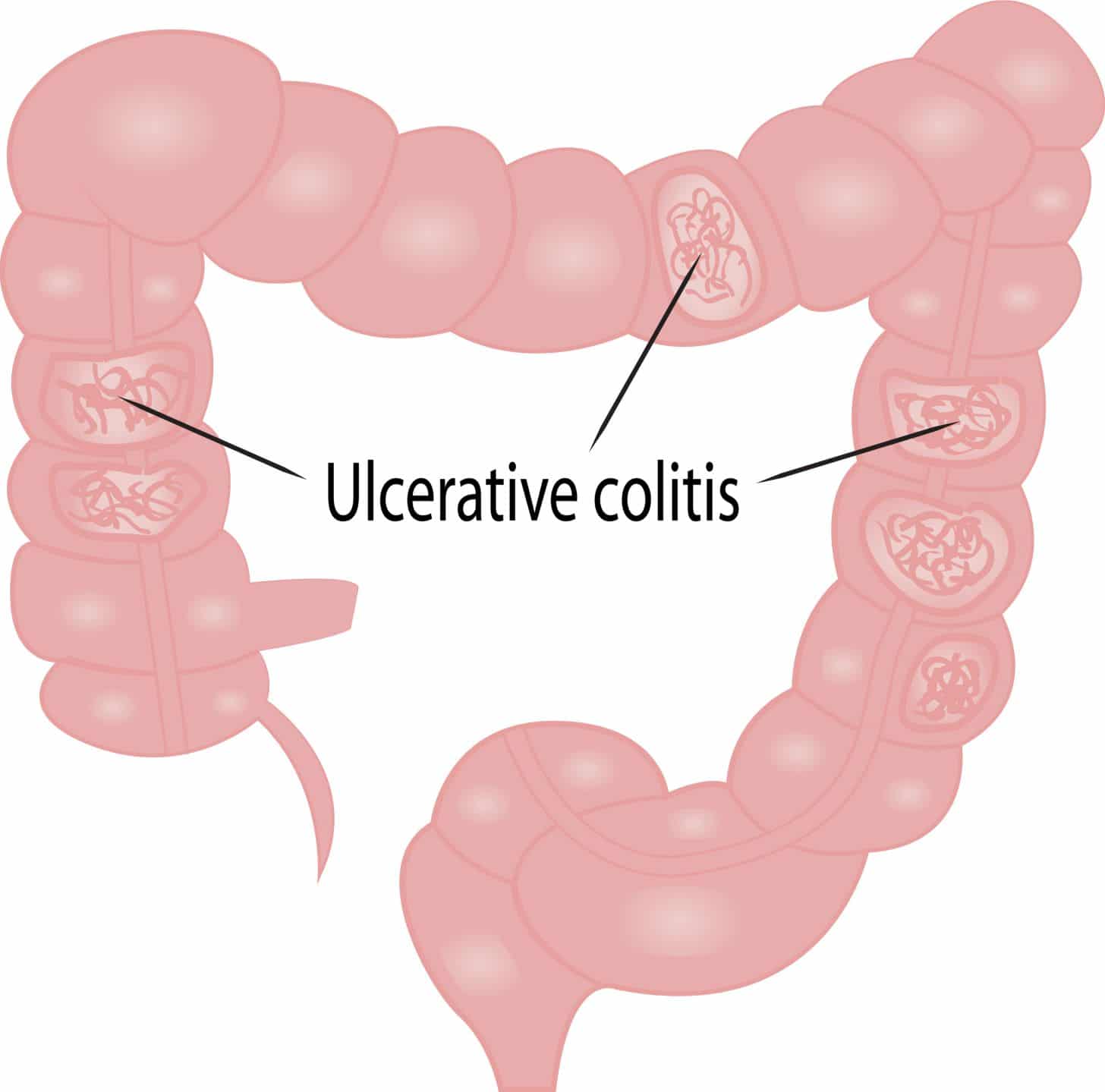 Ulcerative Colitis: Causes &  Symptoms