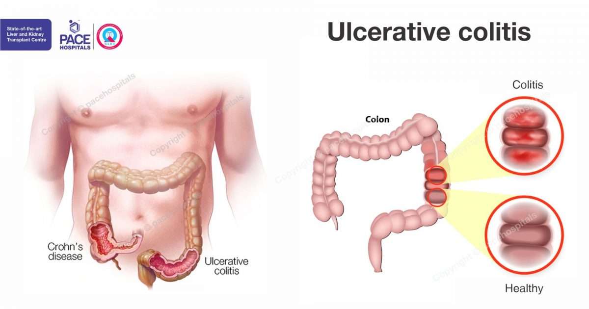 Ulcerative colitis: causes, symptoms, complications and treatment