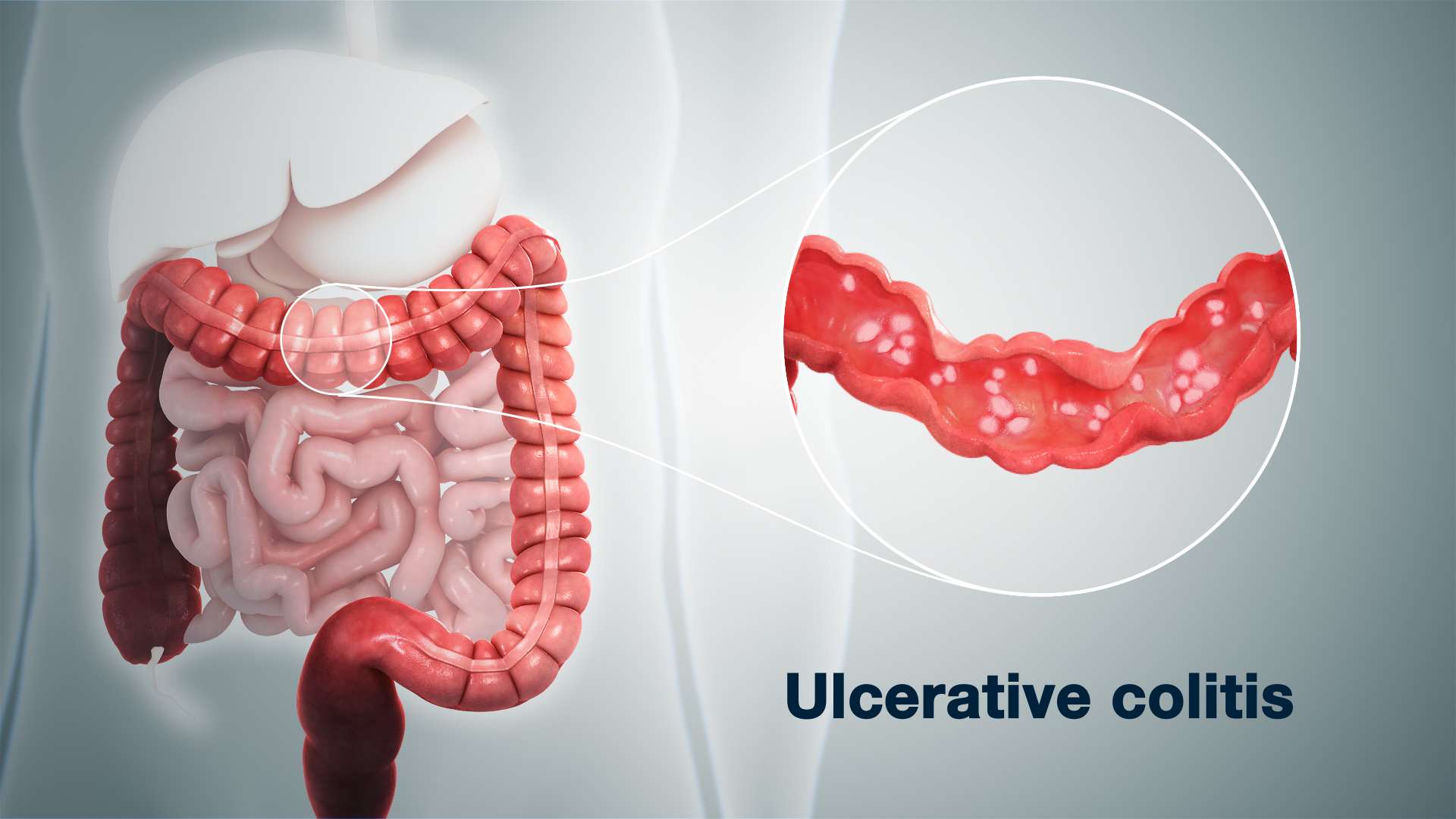 Ulcerative Colitis Causes &  Treatment depicted using 3D medical aniamion