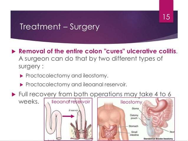 Ulcerative colitis , crohn