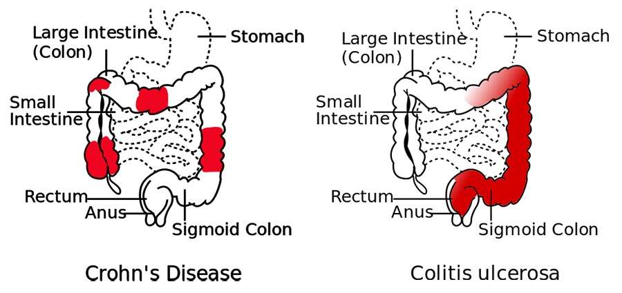 Ulcerative Colitis Diet Wikipedia