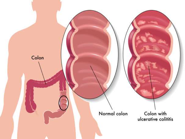 Ulcerative Colitis: Foods that Make UC Worse