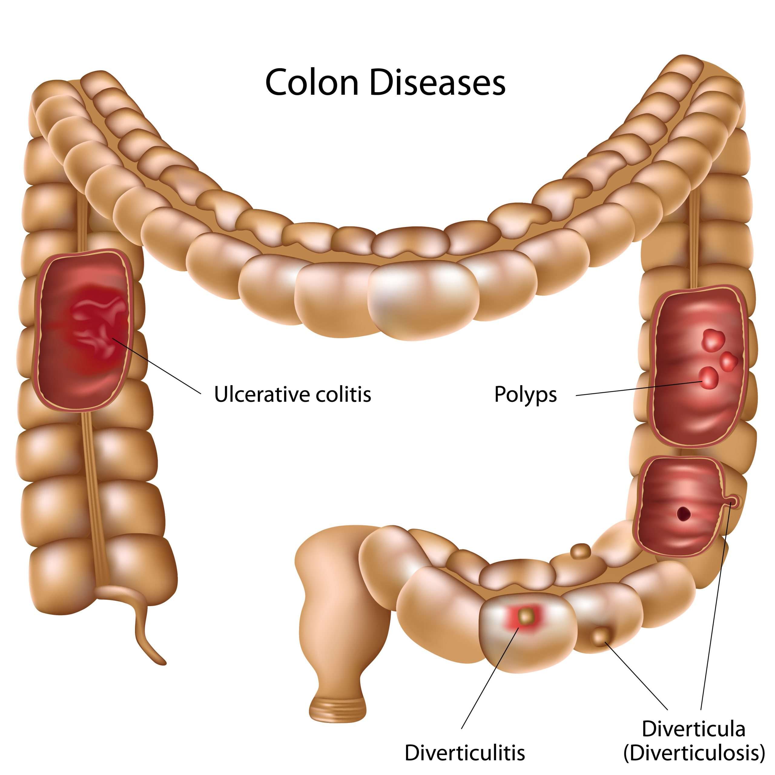 Ulcerative Colitis : GiCare.com