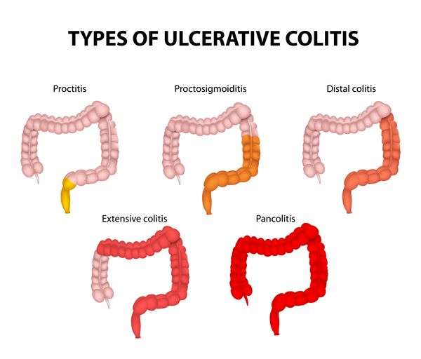 Ulcerative Colitis Market â Global Industry Insights ...