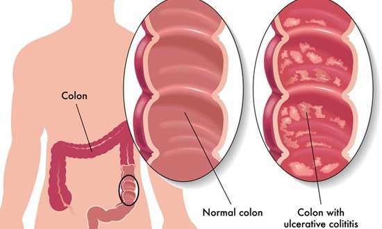Ulcerative Colitis: Symptoms, Causes and Natural Treatment ...