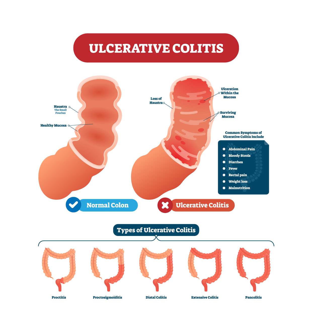Ulcerative Colitis Treatment